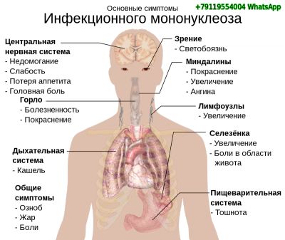 Инфекционный мононуклеоз (болезнь Филатова, болезнь поцелуев)